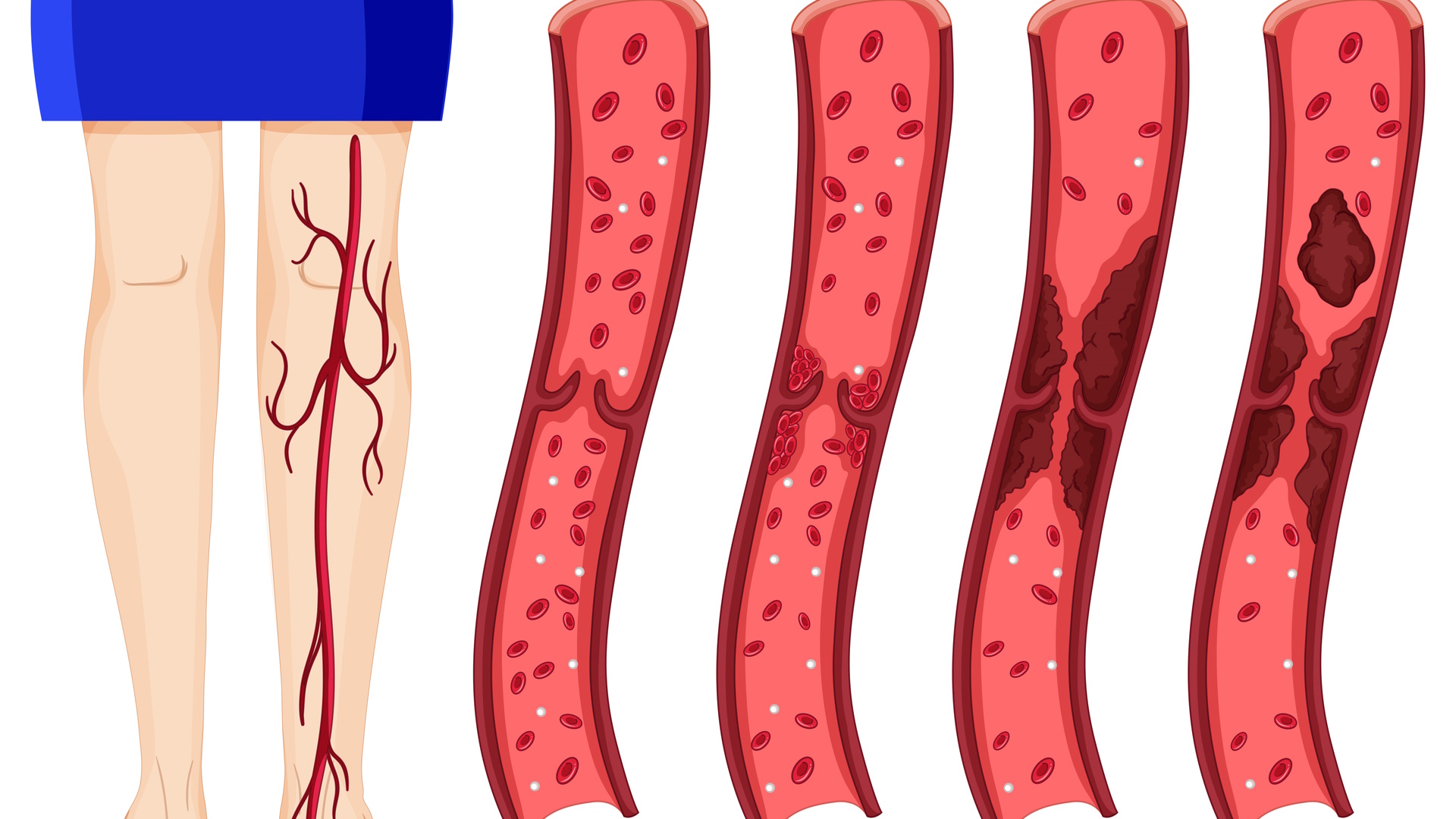 Deep Vein Thrombosis (DVT): Causes, symptoms and how to prevent this silent  threat