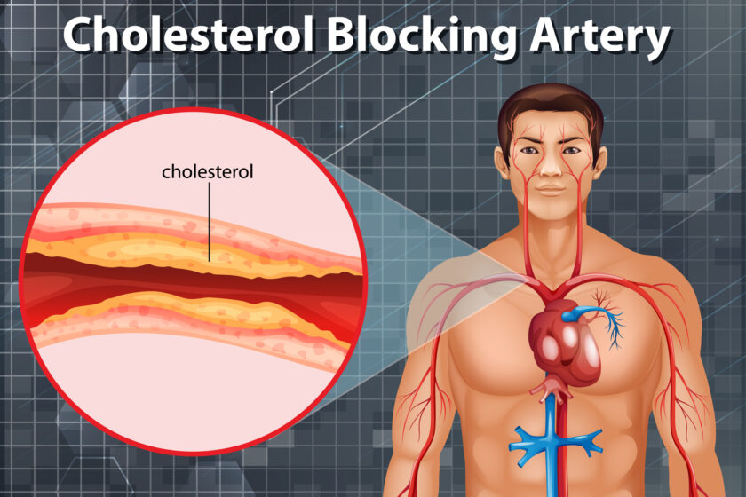 Diagram showing cholesterol blocking artery in human body illustration