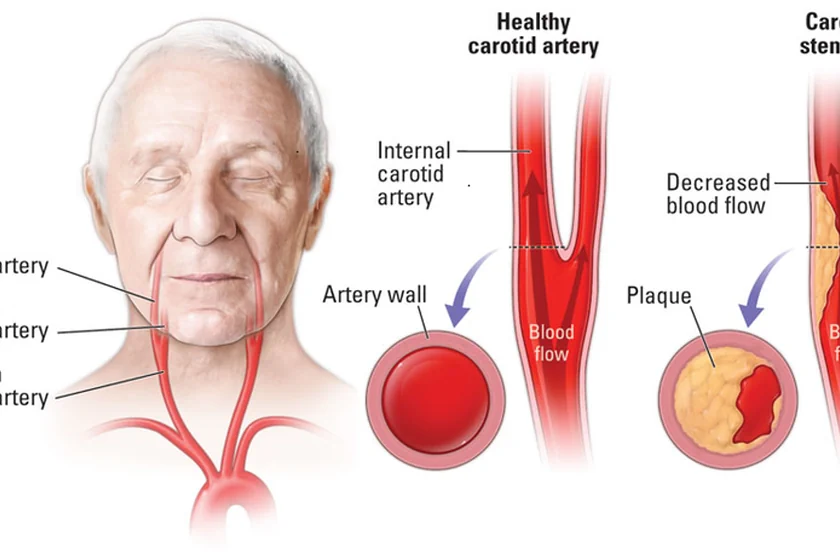 Understanding Carotid Artery Stenosis: Causes, Symptoms, and Treatment Options