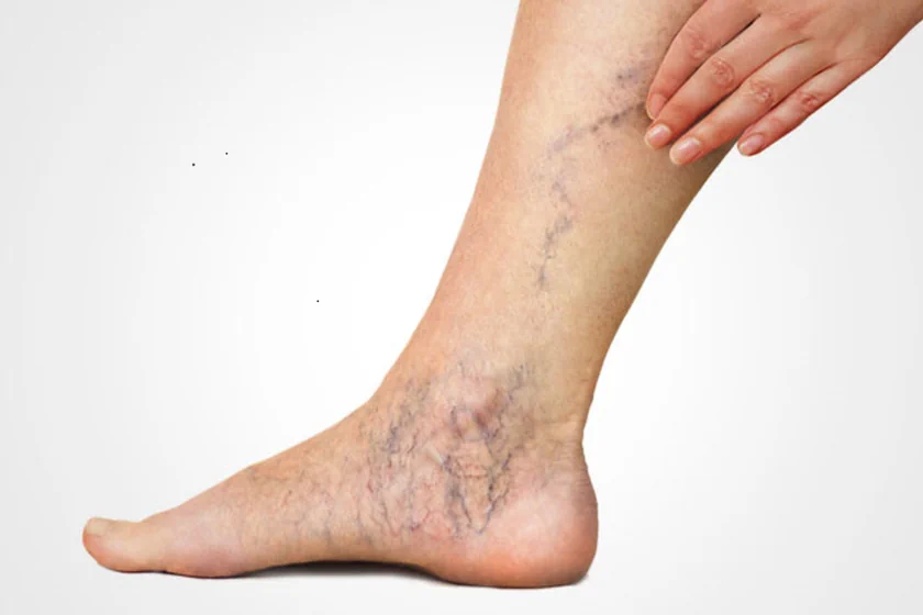 Varicose Vein Defense: Tips for Workers Who Spend Hours on Their Feet