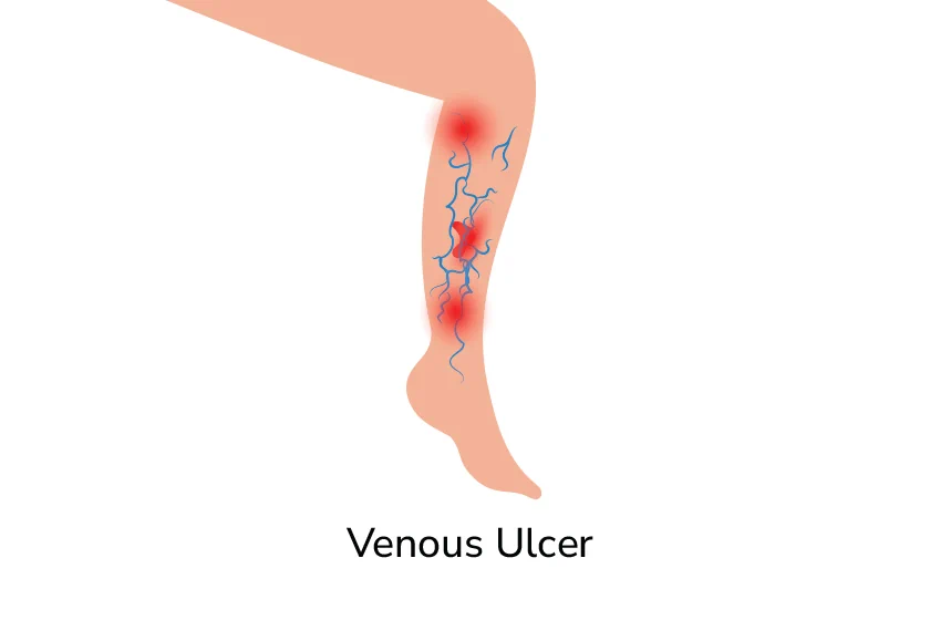 What is Venous Ulcer? Symptoms, Diagnosis, and Treatment Options by Dr. Sumit Kapadia