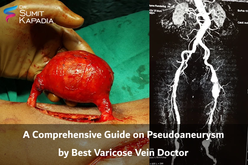 A Comprehensive Guide on Pseudoaneurysm by Best Varicose Vein Doctor