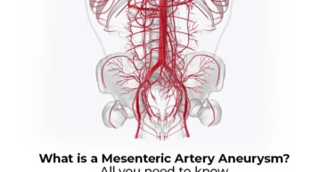 Mesenteric Artery Aneurysm