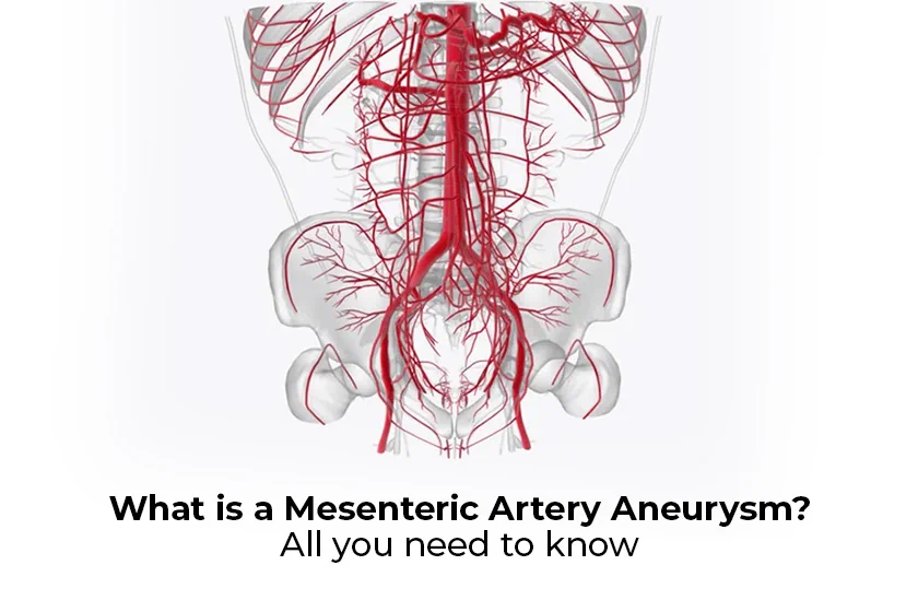 Mesenteric Artery Aneurysm
