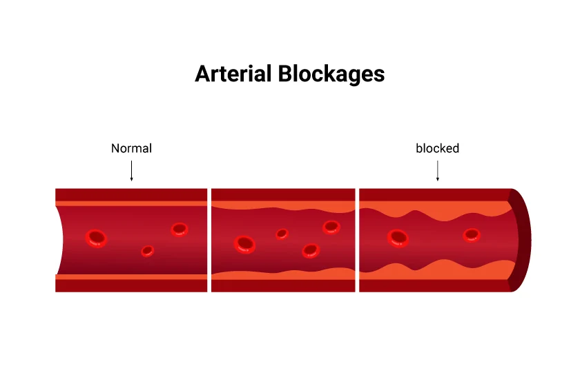 Children and Sugar: Preventing Arterial Blockages from a Young Age