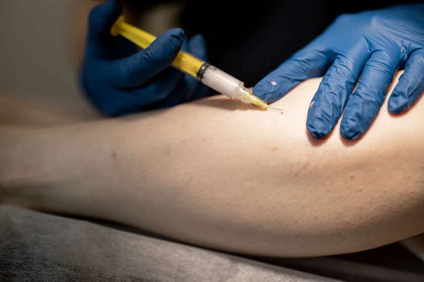 What is Sclerotherapy? Uses, Price, What to Expect, and All Else You Need to Know