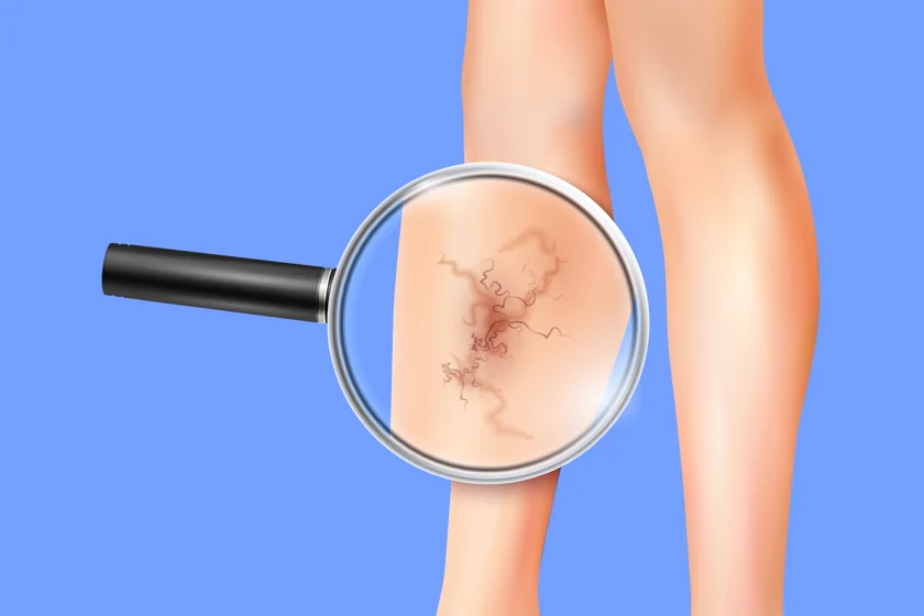 Understanding the Types Of Varicose Vein Treatments