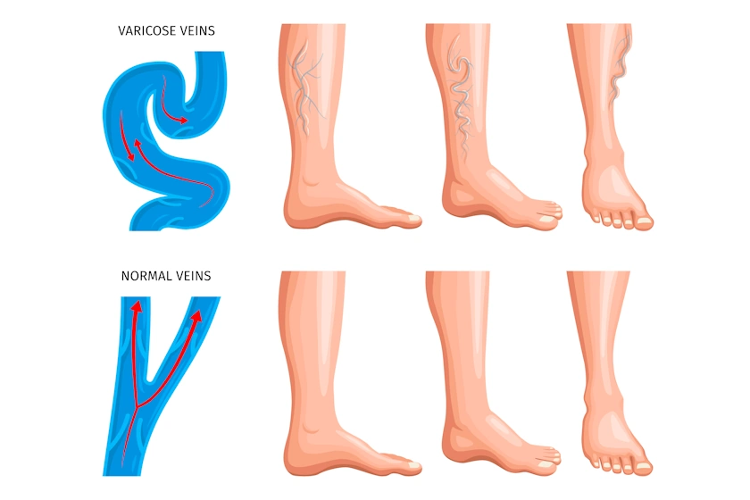 Surgery Vs Laser Treatment For Varicose Veins