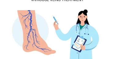 varicose veins treatment