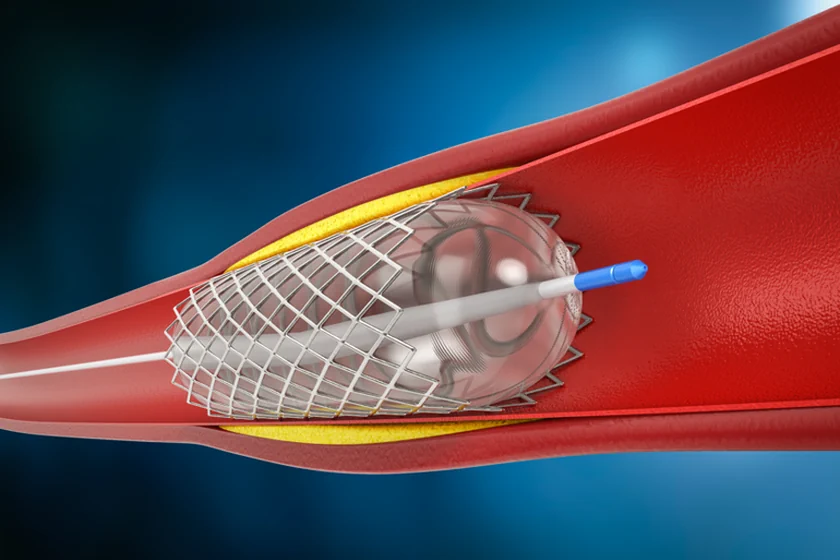 Understanding Intracranial Angioplasty & Stenting: Guide by Dr. Sumit Kapadia