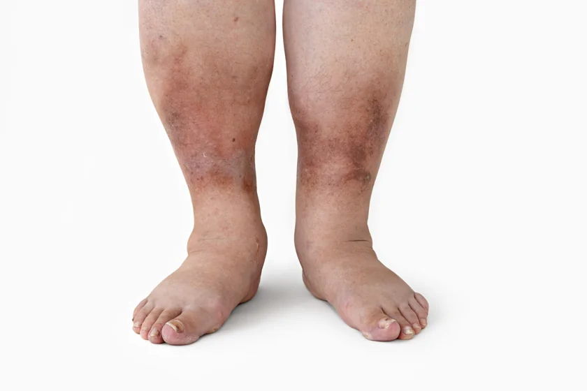 When to See a Vascular Doctor for Leg Swelling: Signs, Causes, and Treatment Options