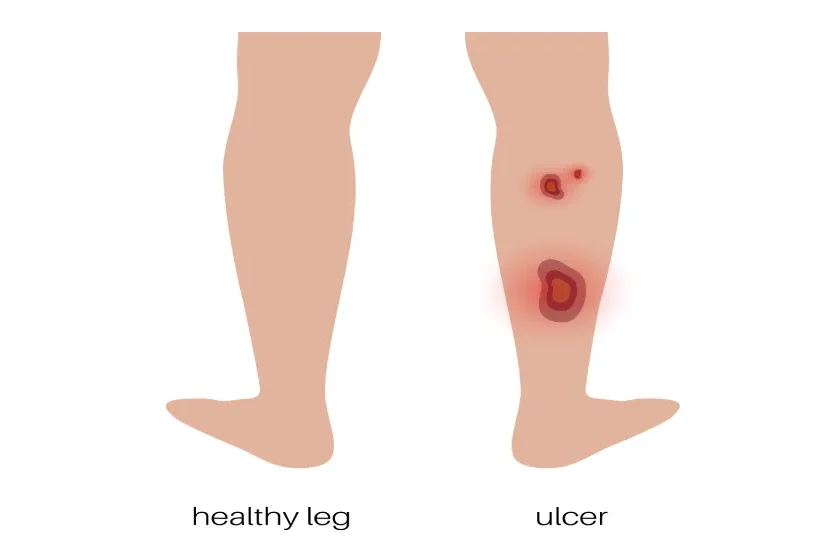 Arterial vs Venous Ulcers