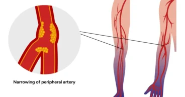 untreated peripheral arterial disease