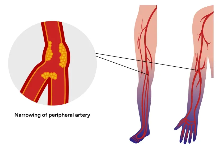 untreated peripheral arterial disease