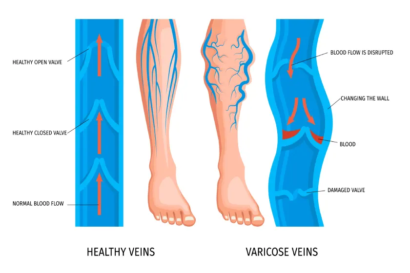 Varicose Vein Thrombosis Risks