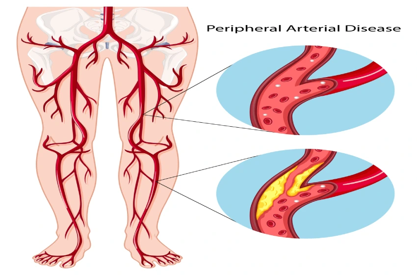 Peripheral Arterial Disease (PAD) Treatment in India: A Comprehensive Guide